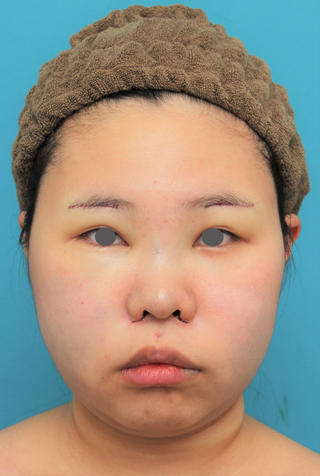 症例写真,顔（頬～フェイスライン～顎下）の脂肪吸引をした20代女性の症例写真,手術直後,mainpic_shibo006b.jpg