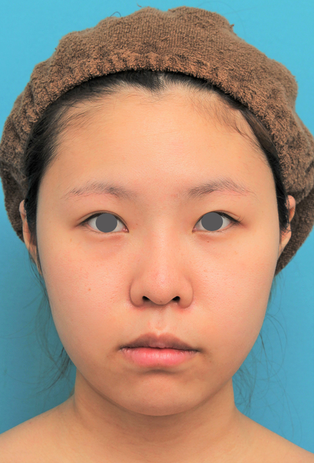 症例写真,顔（頬～フェイスライン～顎下）の脂肪吸引をした20代女性の症例写真,2ヶ月後,mainpic_shibo006e.jpg