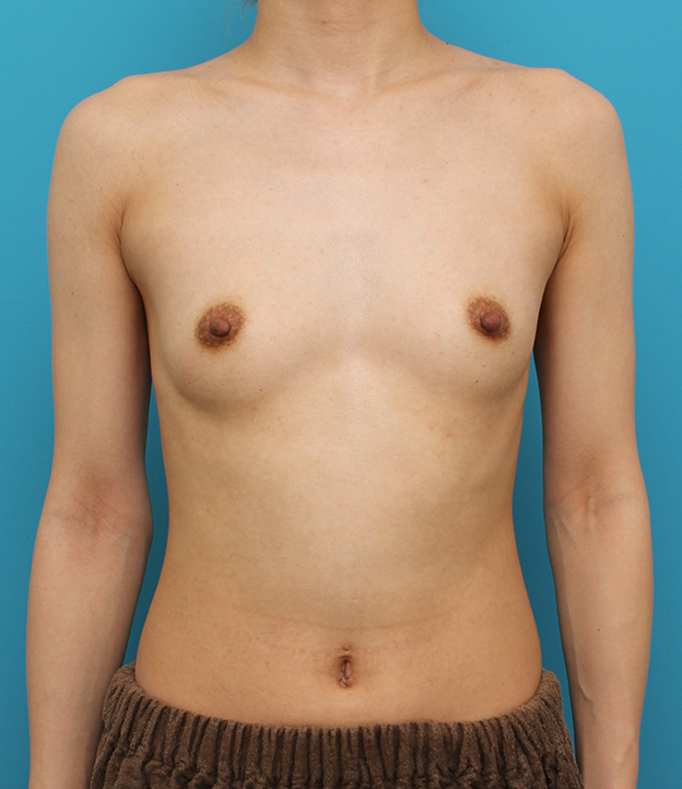 症例写真,シリコンプロテーゼ180ccで豊胸手術した20代女性の症例写真,手術前,mainpic_hokyo035a.jpg