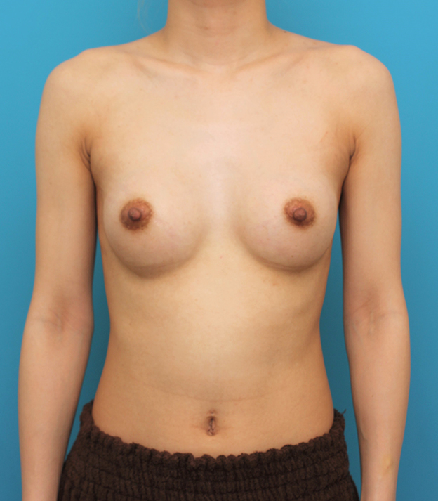豊胸手術（シリコンプロテーゼ）,シリコンプロテーゼ180ccで豊胸手術した20代女性の症例写真,1週間後,mainpic_hokyo035c.jpg