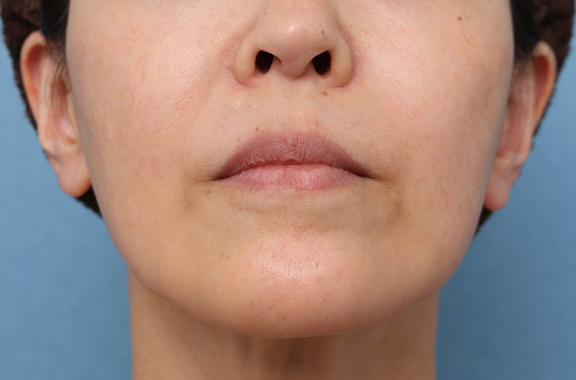 症例写真,口まわり、顎のヒアルロン酸＆ボツリヌストキシン注射の症例写真,After（治療後1ヶ月後）,ba_botox016_b01.jpg