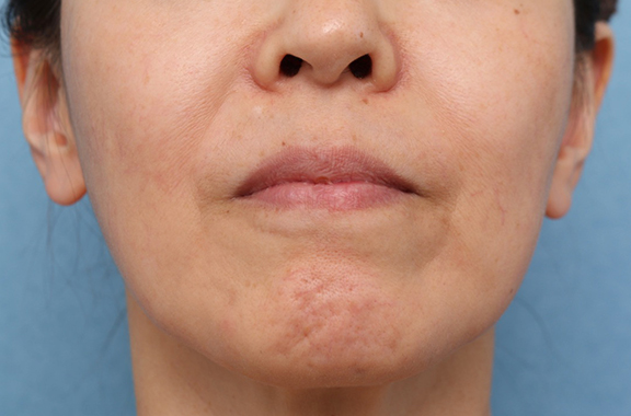 症例写真,口まわり、顎のヒアルロン酸＆ボツリヌストキシン注射の症例写真,Before,ba_botox016_b01.jpg