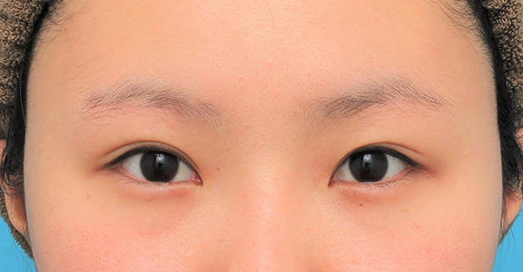 症例写真,眉下リフト（上眼瞼リフト）を行った20代女性の症例写真,After（6ヶ月後）,ba_jougankenlift011_b01.jpg