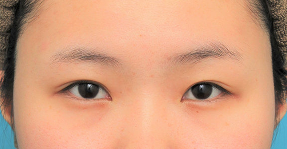 症例写真,眉下リフト（上眼瞼リフト）を行った20代女性の症例写真,Before,ba_jougankenlift011_b01.jpg