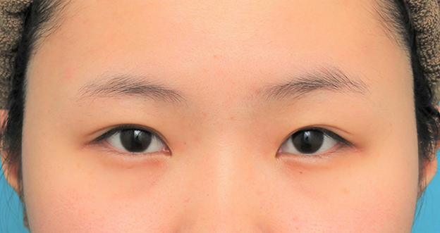 症例写真,眉下リフト（上眼瞼リフト）を行った20代女性の症例写真,手術前,mainpic_jougankenlift011a.jpg