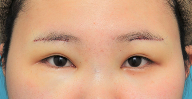 症例写真,眉下リフト（上眼瞼リフト）を行った20代女性の症例写真,手術直後,mainpic_jougankenlift011b.jpg
