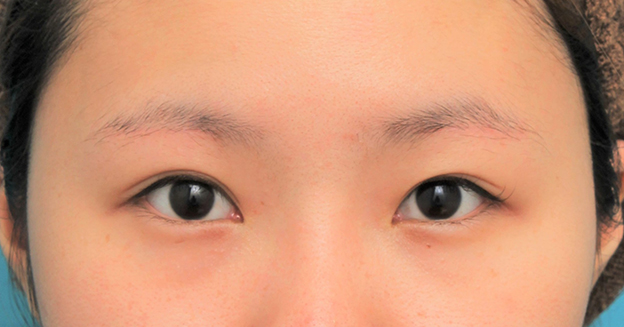 症例写真,眉下リフト（上眼瞼リフト）を行った20代女性の症例写真,2ヶ月後,mainpic_jougankenlift011e.jpg