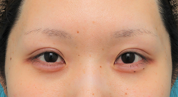 症例写真,涙袋ヒアルロン酸注射を行った20代女性の症例写真,After（1ヶ月後）,ba_namida016_b01.jpg