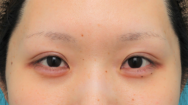 症例写真,涙袋ヒアルロン酸注射を行った20代女性の症例写真,1ヶ月後,mainpic_namida016d.jpg