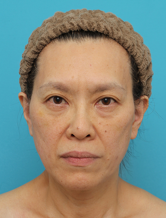 症例写真,Vシェイプリフト（ヒアルロン酸注射）の症例 目の下のタルミが強い60代女性,After（1週間後）,ba_v_shapelift022_b01.jpg