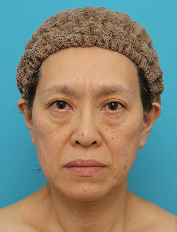 Vシェイプリフト（ヒアルロン酸注射）の症例 目の下のタルミが強い60代女性,Before,ba_v_shapelift022_b01.jpg