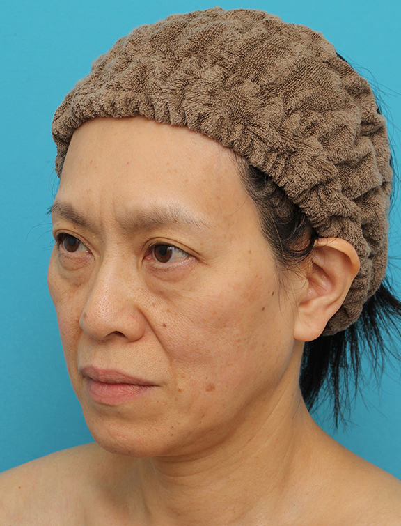 症例写真,Vシェイプリフト（ヒアルロン酸注射）の症例 目の下のタルミが強い60代女性,Before,ba_v_shapelift022_b03.jpg