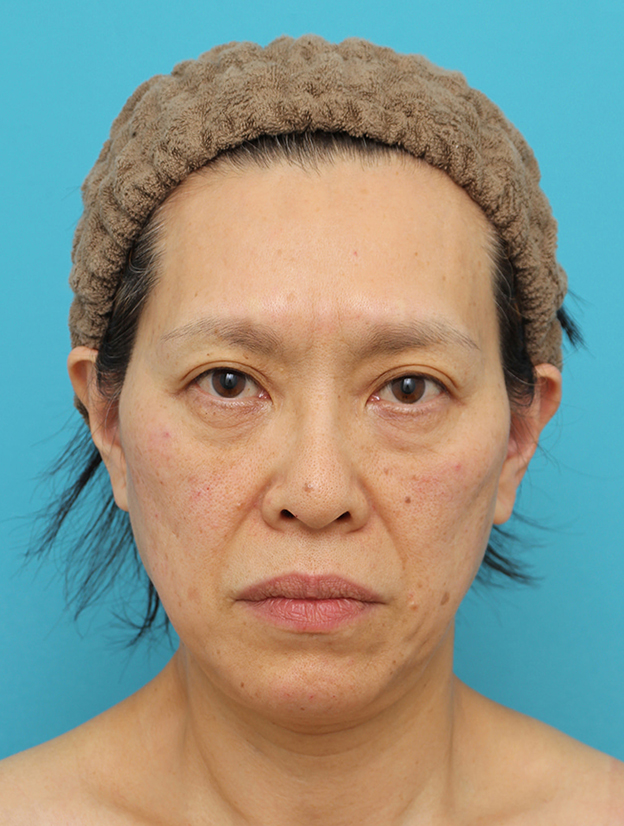 症例写真,Vシェイプリフト（ヒアルロン酸注射）の症例 目の下のタルミが強い60代女性,治療直後,mainpic_v_shapelift022b.jpg