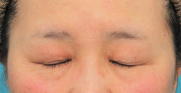 症例写真,片目の眼瞼下垂手術を行い、左右差を治した60代女性の症例写真,After（6ヶ月後の目を閉じた状態）,ba_ganken042_b02.jpg