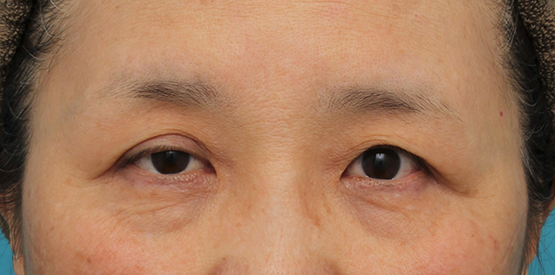 症例写真,片目の眼瞼下垂手術を行い、左右差を治した60代女性の症例写真,手術前,mainpic_ganken042a.jpg
