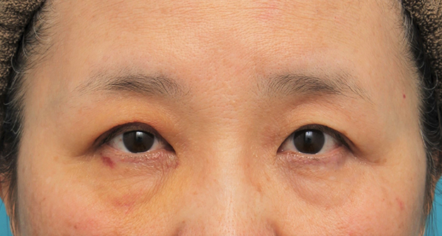 症例写真,片目の眼瞼下垂手術を行い、左右差を治した60代女性の症例写真,6日後,mainpic_ganken042e.jpg
