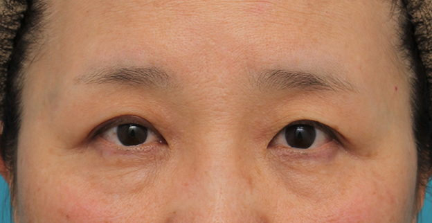症例写真,片目の眼瞼下垂手術を行い、左右差を治した60代女性の症例写真,3週間後,mainpic_ganken042g.jpg