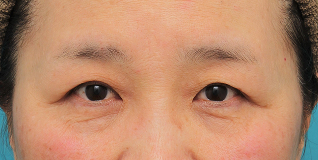症例写真,片目の眼瞼下垂手術を行い、左右差を治した60代女性の症例写真,6ヶ月後,mainpic_ganken042i.jpg