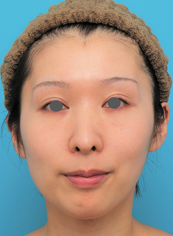 症例写真,顎にシリコンプロテーゼを入れた20代女性の症例写真,After（6ヶ月後）,ba_ago022_b01.jpg