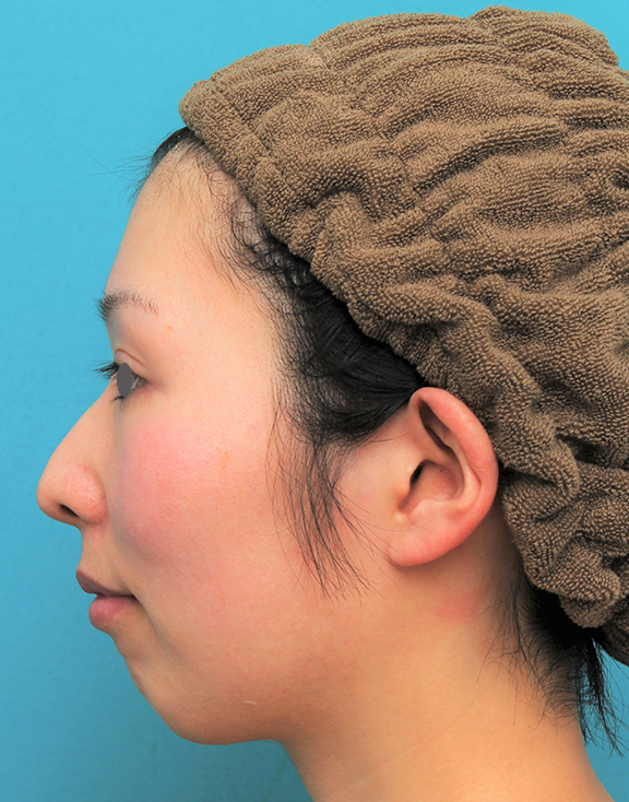 症例写真,顎にシリコンプロテーゼを入れた20代女性の症例写真,Before,ba_ago022_b03.jpg