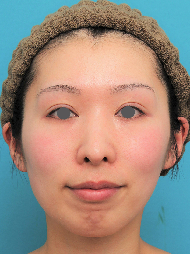 症例写真,顎にシリコンプロテーゼを入れた20代女性の症例写真,手術前,mainpic_ago022a.jpg