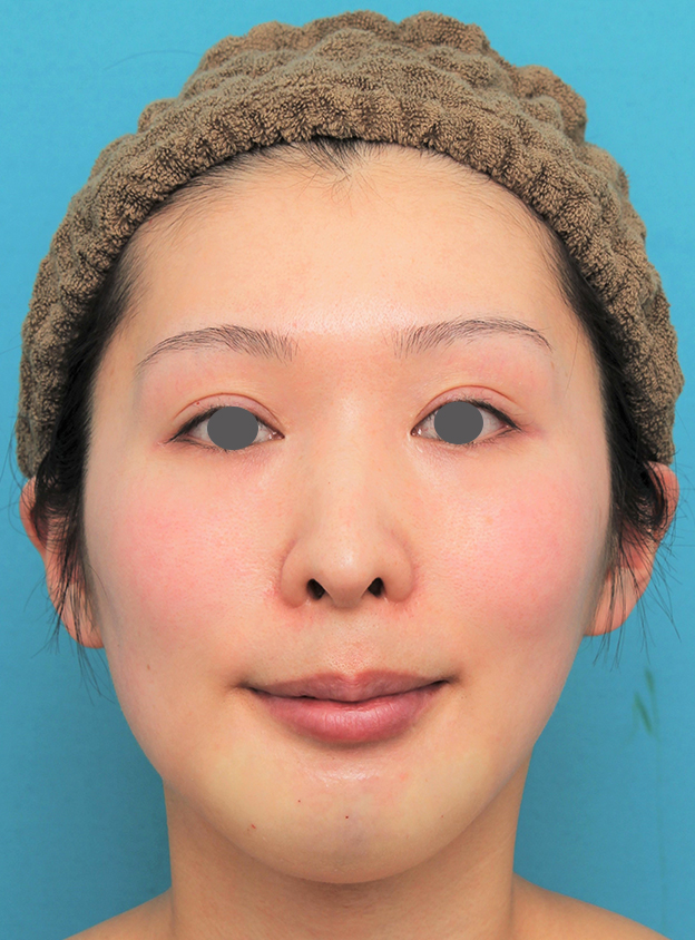 症例写真,顎にシリコンプロテーゼを入れた20代女性の症例写真,手術直後,mainpic_ago022b.jpg
