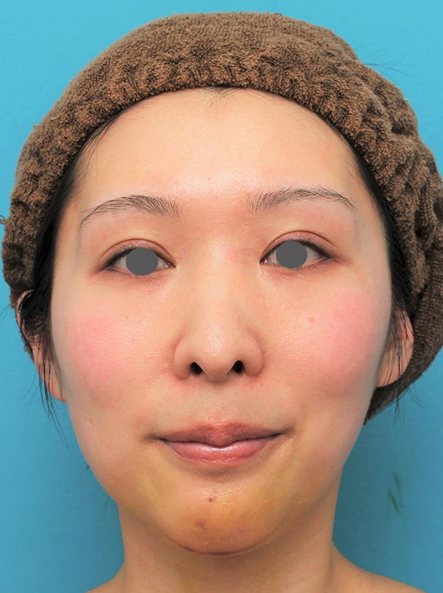 症例写真,顎にシリコンプロテーゼを入れた20代女性の症例写真,6日後,mainpic_ago022c.jpg