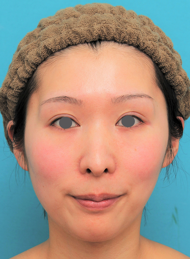 症例写真,顎にシリコンプロテーゼを入れた20代女性の症例写真,3週間後,mainpic_ago022d.jpg