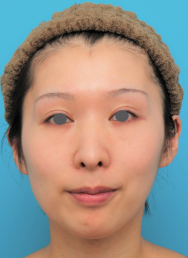 症例写真,顎にシリコンプロテーゼを入れた20代女性の症例写真,6ヶ月後,mainpic_ago022e.jpg