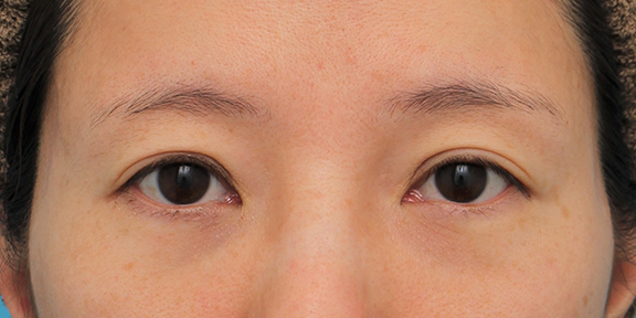 症例写真,目の下の脂肪の膨らみを取り、クマを改善させた30代女性の症例写真,After（6ヶ月後）,ba_shibo14_b01.jpg