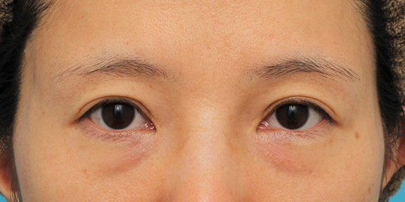 症例写真,目の下の脂肪の膨らみを取り、クマを改善させた30代女性の症例写真,Before,ba_shibo14_b01.jpg