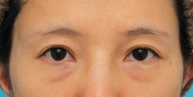 症例写真,目の下の脂肪の膨らみを取り、クマを改善させた30代女性の症例写真,手術前,mainpic_shibo14a.jpg
