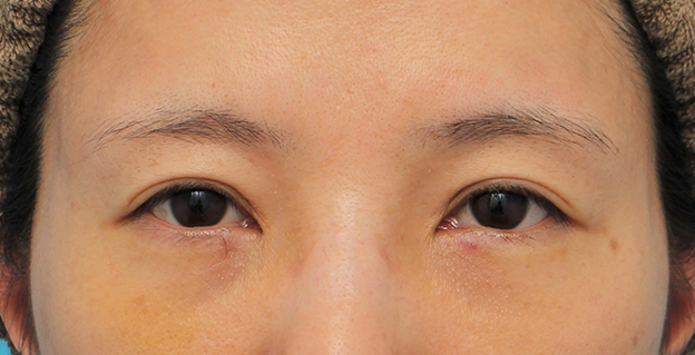 症例写真,目の下の脂肪の膨らみを取り、クマを改善させた30代女性の症例写真,6日後,mainpic_shibo14c.jpg