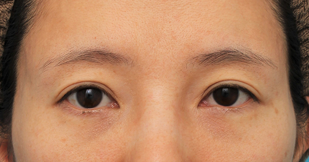 症例写真,目の下の脂肪の膨らみを取り、クマを改善させた30代女性の症例写真,2ヶ月後,mainpic_shibo14e.jpg