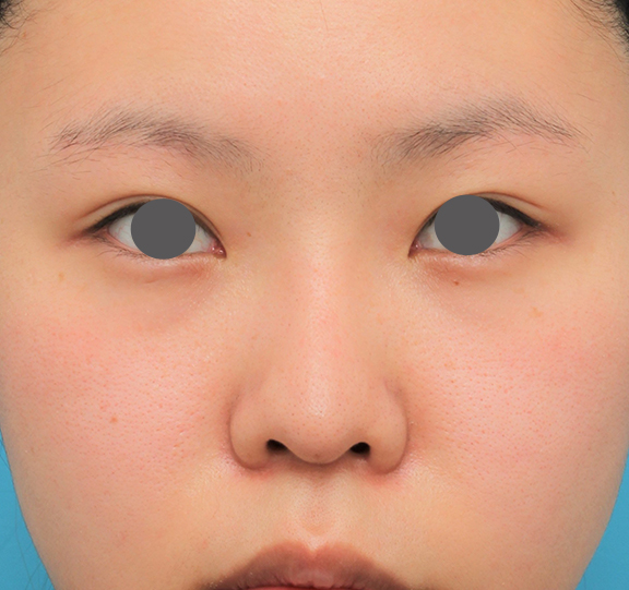 鼻シリコンプロテーゼ+鼻先耳介軟骨移植+小鼻縮小の症例写真,After（6ヶ月後）,ba_ryubi80_a01.jpg