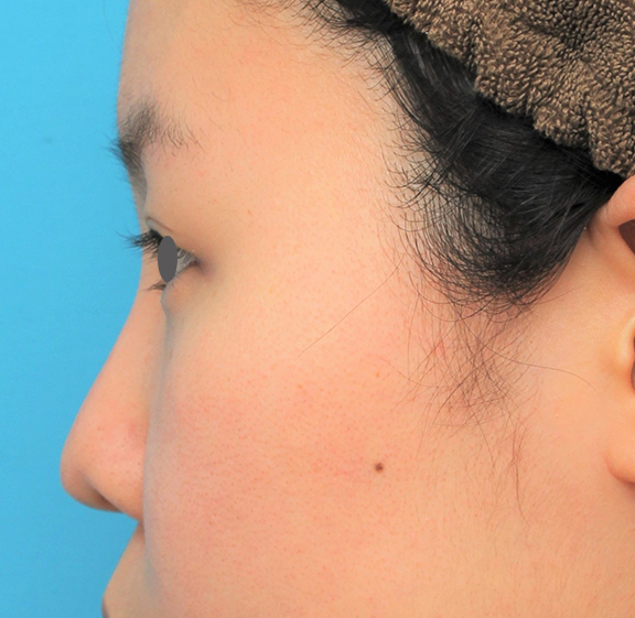 耳介軟骨移植（鼻先を出す）,鼻シリコンプロテーゼ+鼻先耳介軟骨移植+小鼻縮小の症例写真,After（6ヶ月後）,ba_ryubi80_b03.jpg