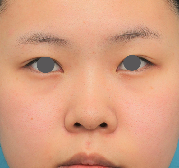 症例写真,鼻シリコンプロテーゼ+鼻先耳介軟骨移植+小鼻縮小の症例写真,Before,ba_ryubi80_b01.jpg