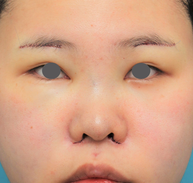 症例写真,鼻シリコンプロテーゼ+鼻先耳介軟骨移植+小鼻縮小の症例写真,手術直後,mainpic_ryubi80b.jpg