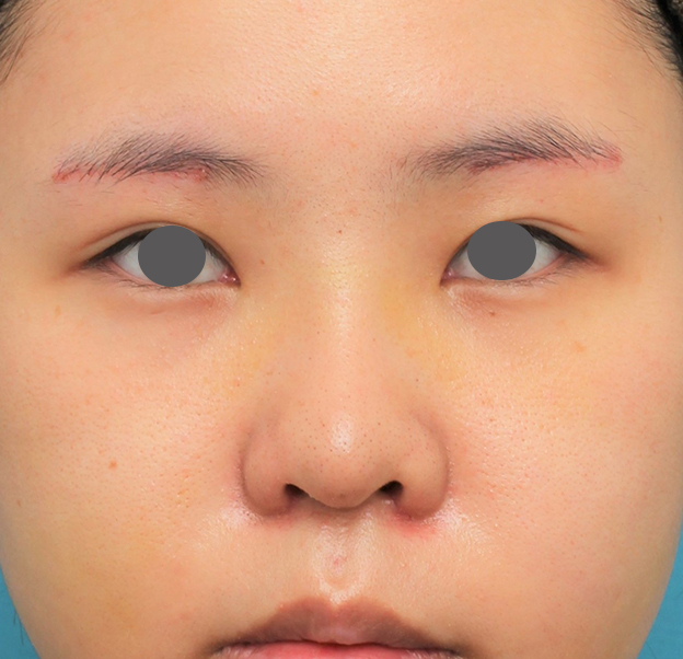 症例写真,鼻シリコンプロテーゼ+鼻先耳介軟骨移植+小鼻縮小の症例写真,6日後,mainpic_ryubi80c.jpg