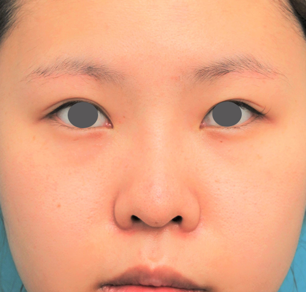症例写真,鼻シリコンプロテーゼ+鼻先耳介軟骨移植+小鼻縮小の症例写真,2ヶ月後,mainpic_ryubi80e.jpg
