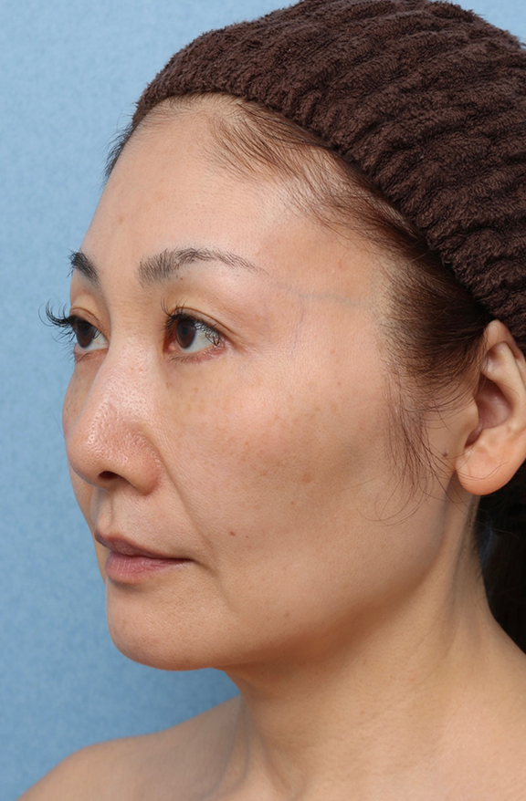 症例写真,Vシェイプリフト(ヒアルロン酸注射)の症例 シワとたるみが気になる50代女性,After(1ヶ月後),ba_v_shapelift023_b02.jpg