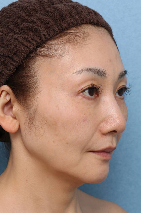 症例写真,Vシェイプリフト(ヒアルロン酸注射)の症例 シワとたるみが気になる50代女性,After(1ヶ月後),ba_v_shapelift023_b03.jpg