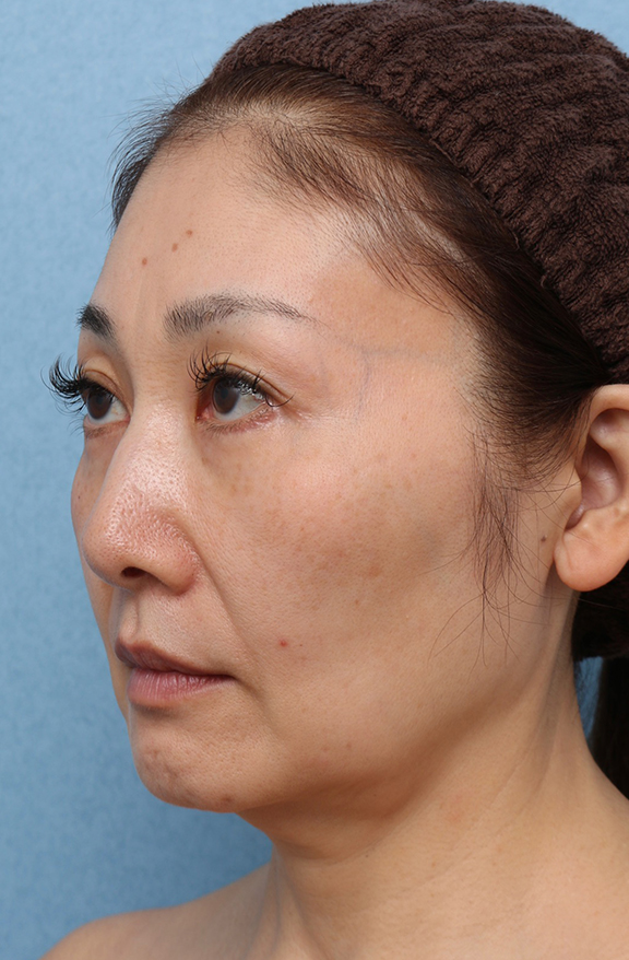 症例写真,Vシェイプリフト(ヒアルロン酸注射)の症例 シワとたるみが気になる50代女性,Before,ba_v_shapelift023_b02.jpg