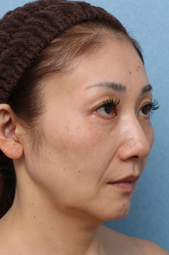 症例写真,Vシェイプリフト(ヒアルロン酸注射)の症例 シワとたるみが気になる50代女性,Before,ba_v_shapelift023_b03.jpg