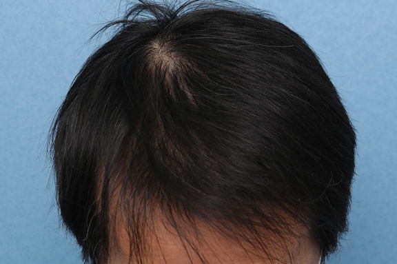 症例写真,男性の育毛治療の症例写真,After（6ヶ月後）,ba_aga030_b01.jpg