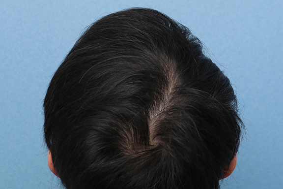 症例写真,男性の育毛治療の症例写真,After（6ヶ月後）,ba_aga030_b02.jpg