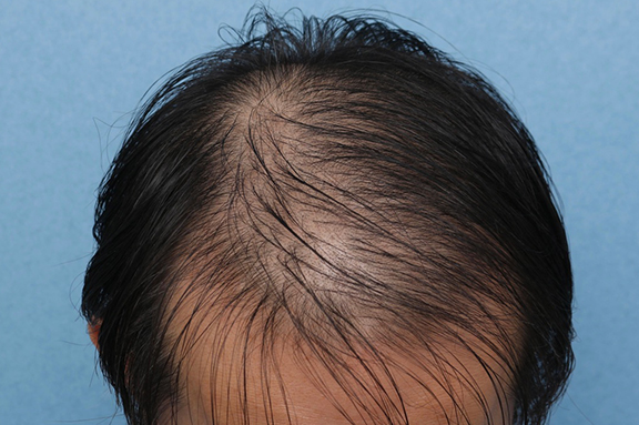 症例写真,男性の育毛治療の症例写真,Before,ba_aga030_b01.jpg