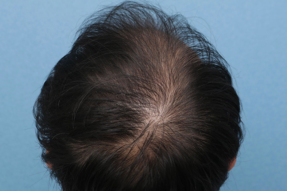 症例写真,男性の育毛治療の症例写真,Before,ba_aga030_b02.jpg