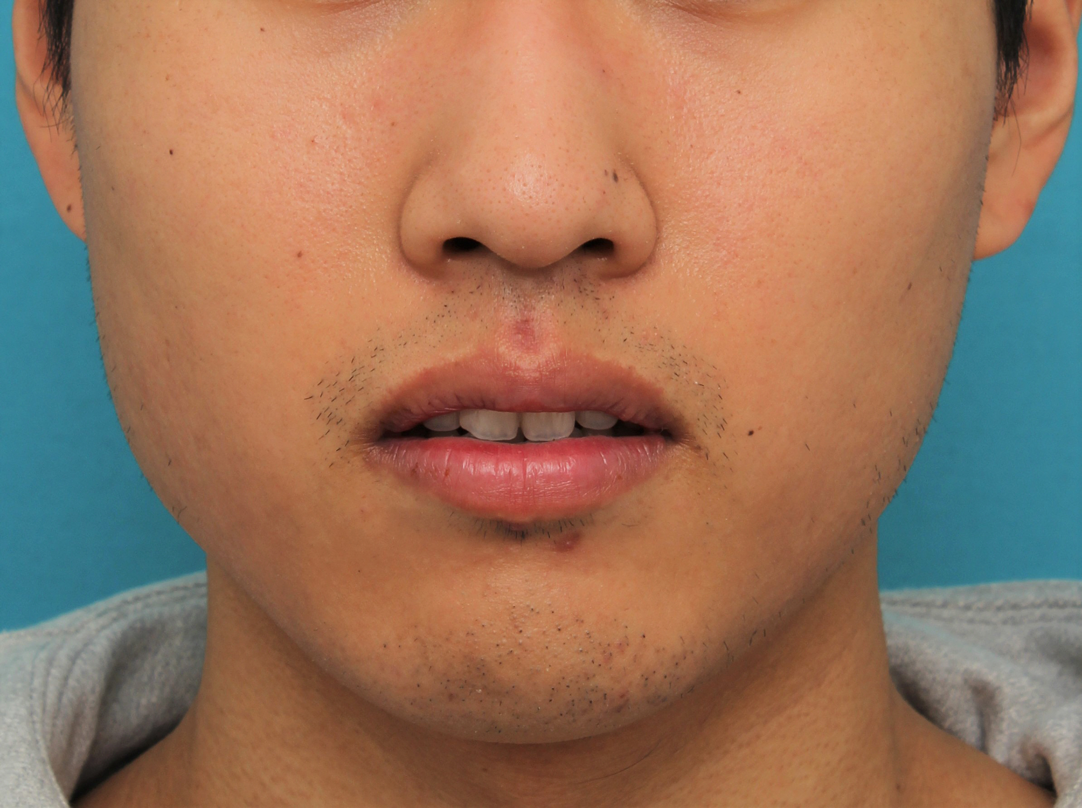 症例写真,手術で上下の唇を薄くした20代男性の症例写真,After（4ヶ月後）,ba_usuku017_b02.jpg