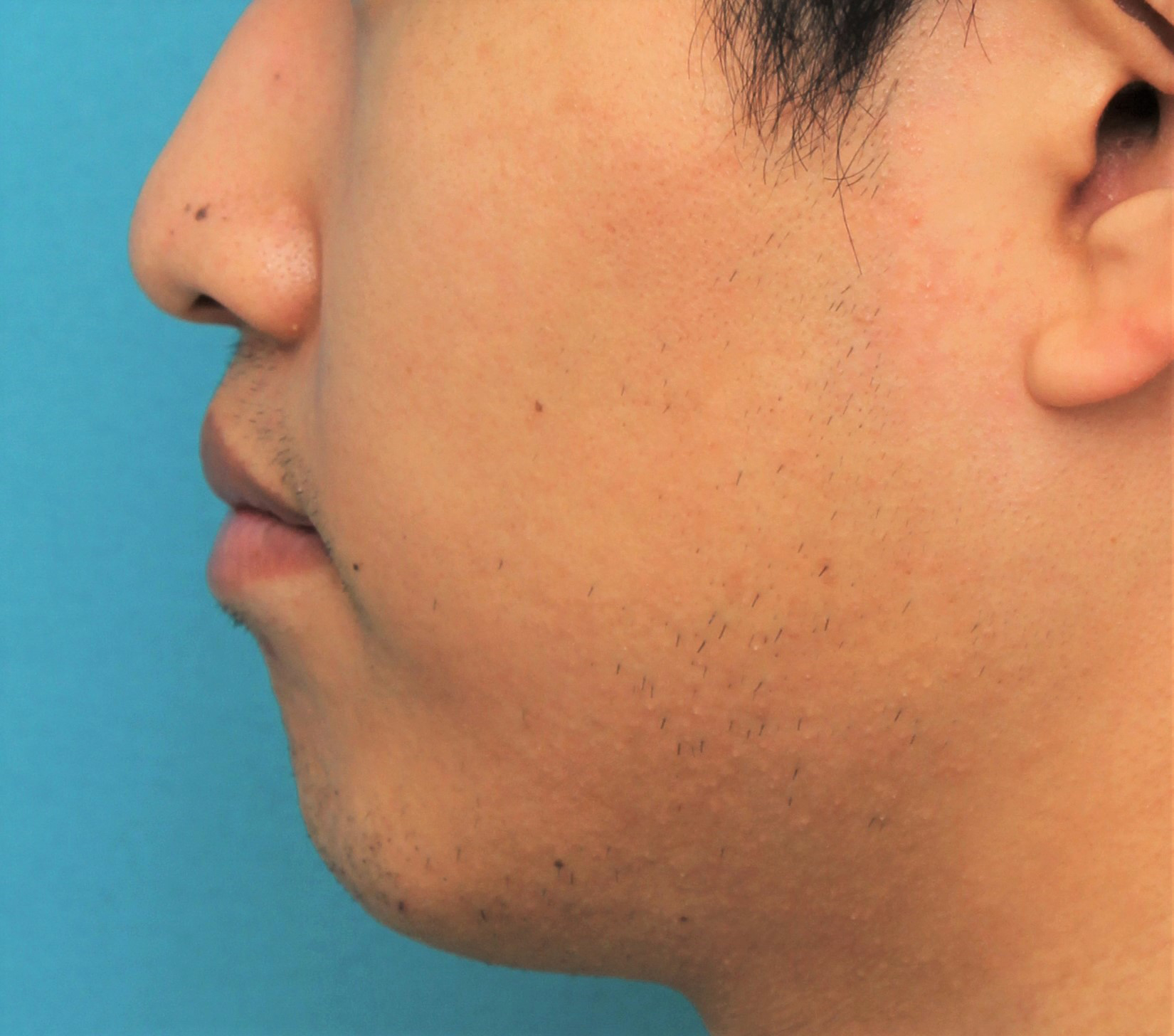 症例写真,手術で上下の唇を薄くした20代男性の症例写真,After（4ヶ月後）,ba_usuku017_b03.jpg